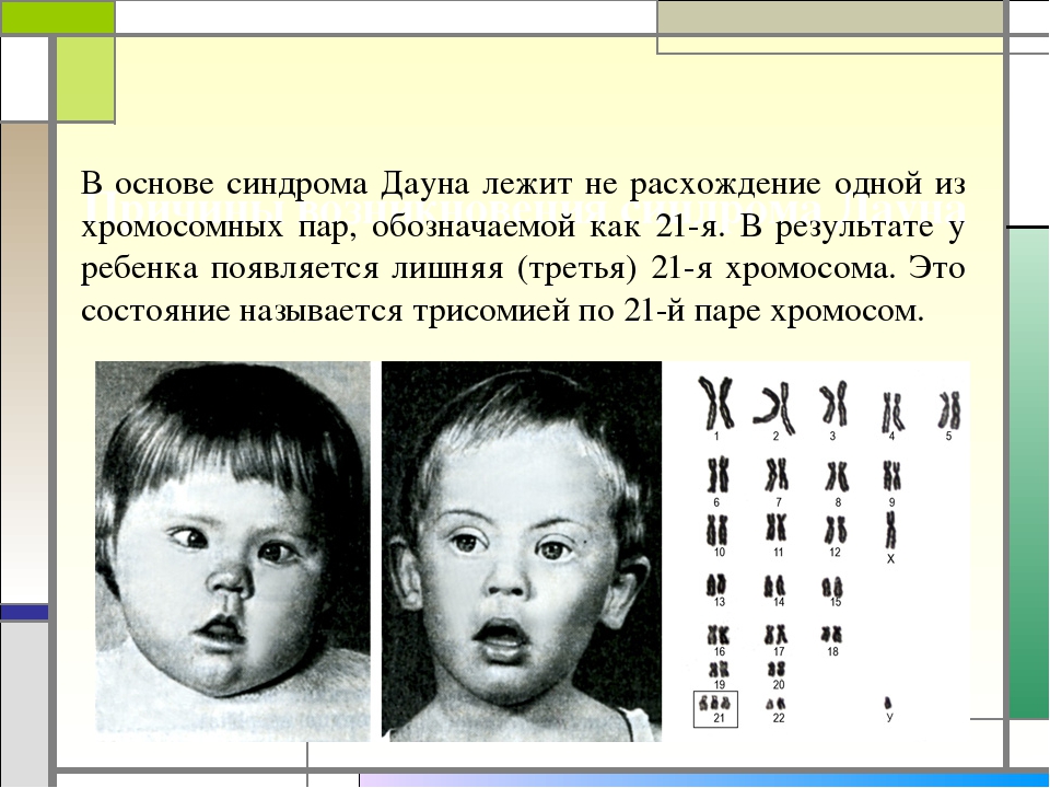 Фенотип ребенка с синдромом дауна. Геномные болезни синдром Дауна. Синдром Дауна трисомия. Синдром Дауна хромосомная мутация.